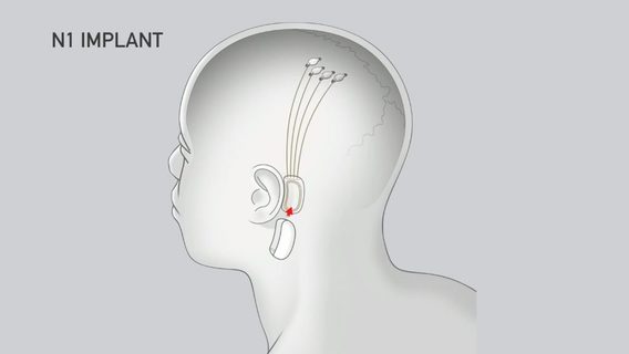 У мозговых чипов Neuralink проблемы с электродами. Их заметили еще во время испытаний на животных