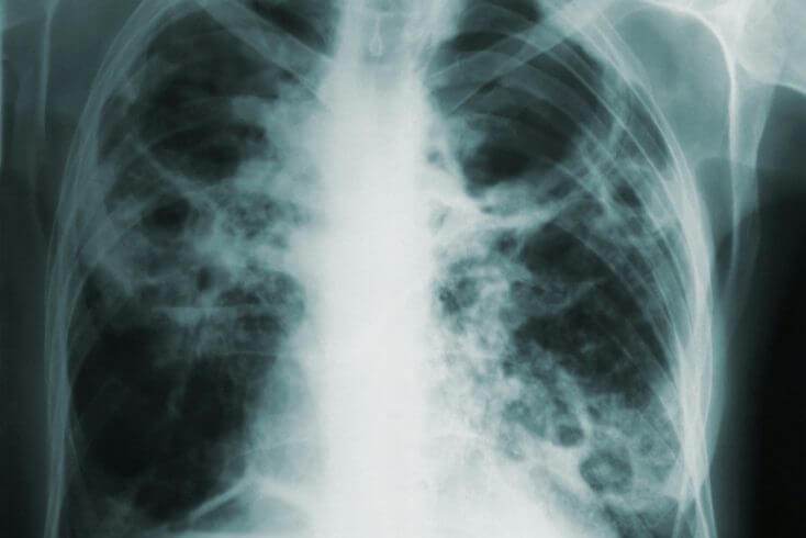 За последнее десятилетие заболеваемость туберкулезом у детей снизилась более чем в 10 раз