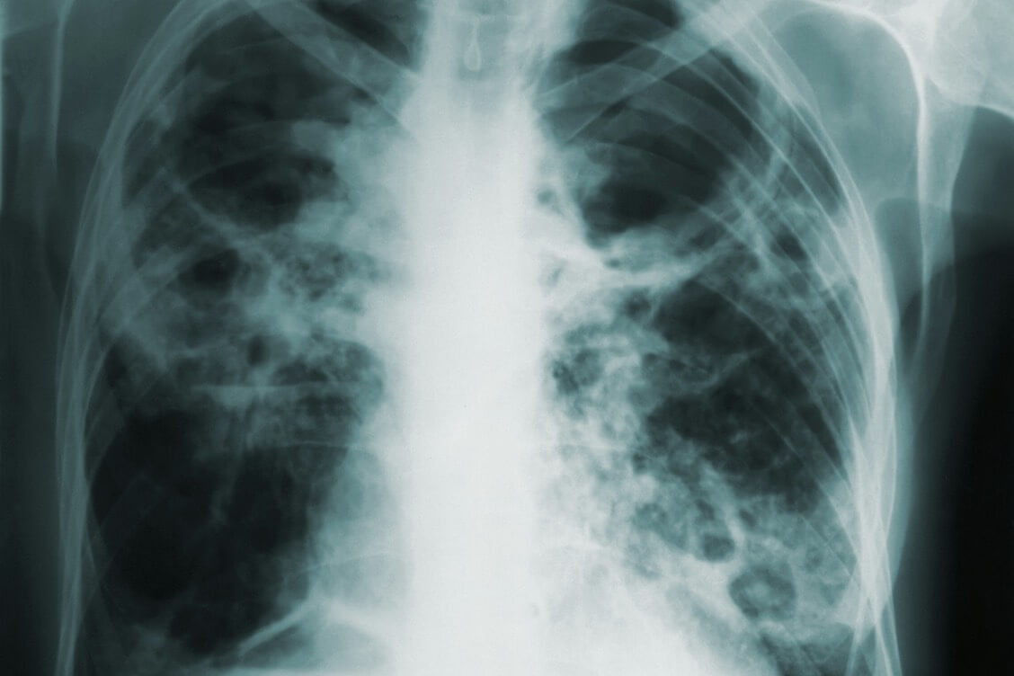 За последнее десятилетие заболеваемость туберкулезом у детей снизилась более чем в 10 раз